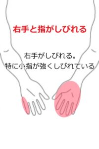 指のしびれ症例3